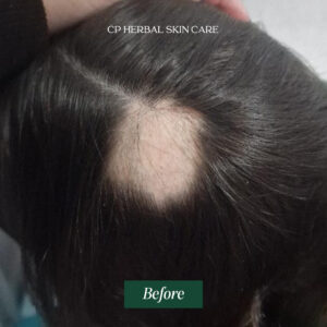 Before photo showing a visible patch of hair loss on the scalp of a customer with alopecia.