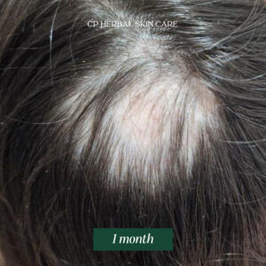 One-month progress photo showing new short hairs becoming visible within the area affected by alopecia.