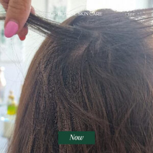 Current photo with the hair lifted to show the coverage of the previously affected scalp area.
