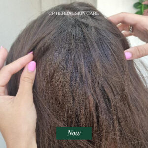 Current photo showing the previously affected scalp area with significantly fuller hair coverage.