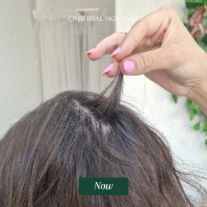 Current photo from another angle showing fuller hair coverage in the area previously affected by alopecia.